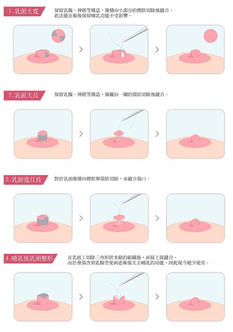 奶頭上長毛|乳頭內凹、長毛正常嗎？ 8類「乳頭形狀」你的是哪種 